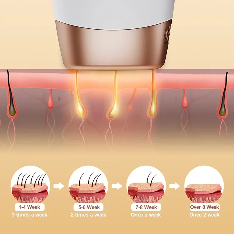 جهاز إزالة الشعر بتقنية IPL (التحليل الضوئي الدائم)