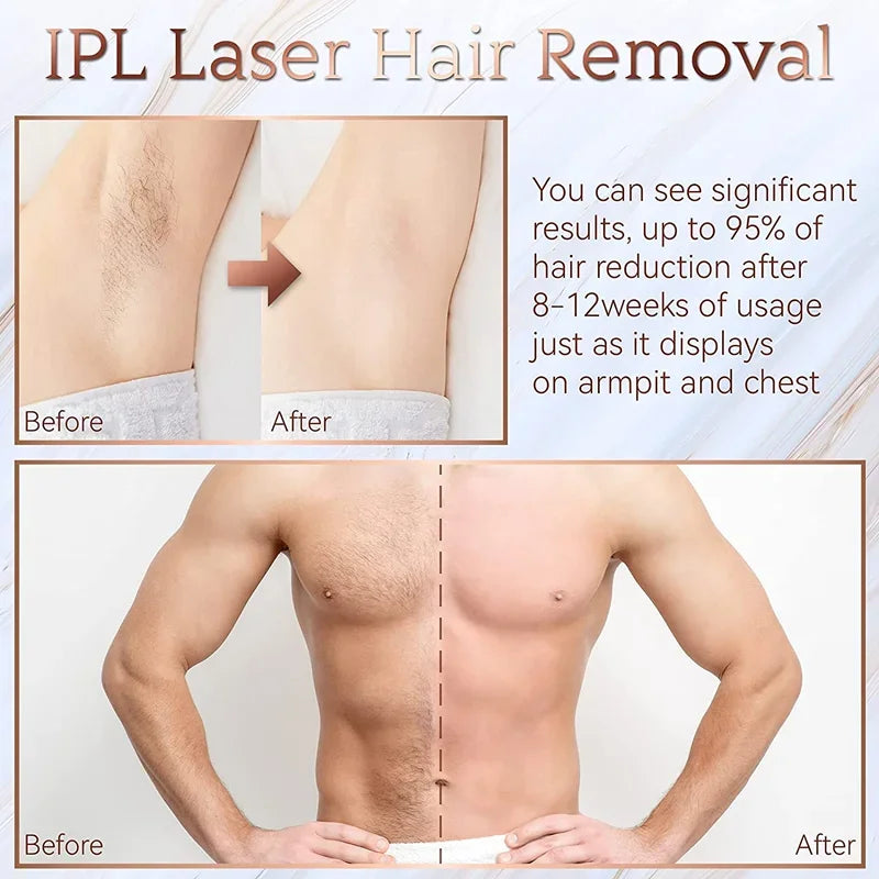 جهاز إزالة الشعر بتقنية IPL (التحليل الضوئي الدائم)