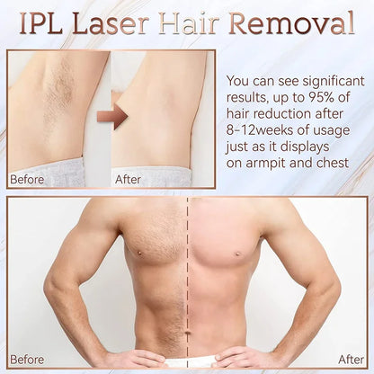 جهاز إزالة الشعر بتقنية IPL (التحليل الضوئي الدائم)